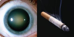 The prevention of cataracts