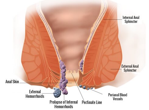 natural treatment for hemorrhoids