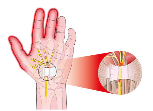 5 Ways to Relieve the Pain from Carpal Tunnel Syndrome