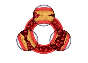 What to Do About High Cholesterol in Women