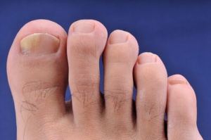 Home Remedies for Onychomycosis (Hands and Feet)