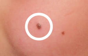 How to Remove Red Moles