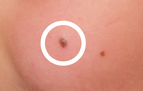 How to Remove Red Moles