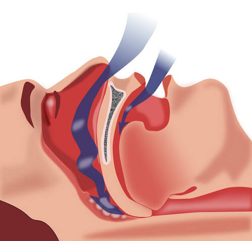 How to Treat Sleep Apnea How to Treat Sleep Apnea