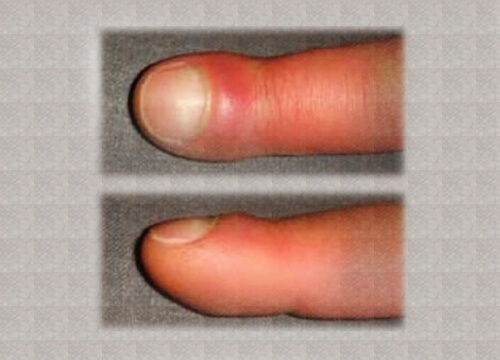 What are Some Causes for Swollen Fingers?