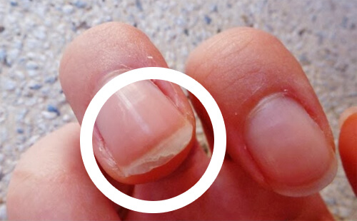 Why Your Nails Peel and How to Treat Them
