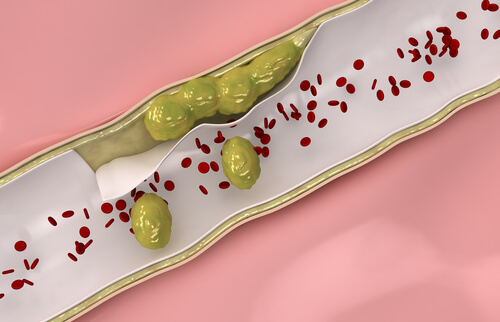 Natural Remedies for Cleaner Arteries