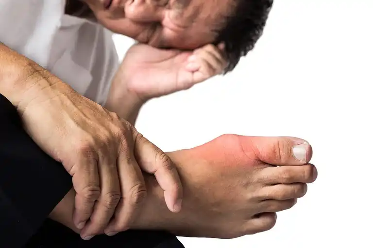 Gout consulation