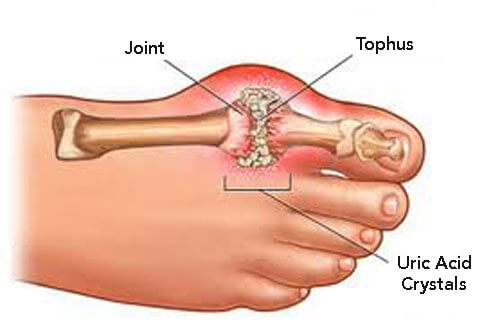 Formation of uric acid crystals