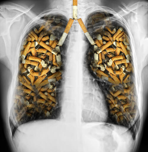Lungs filled with cigarettes to illustrate why you should quit smoking