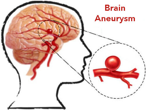 Brain Aneurysms: What Are They and How to Prevent Them