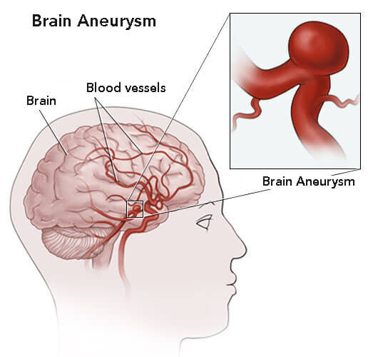 Aneurysms in the brain