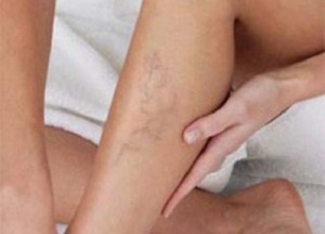 How to Control Poor Blood Circulation