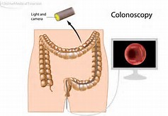 colonoscopy