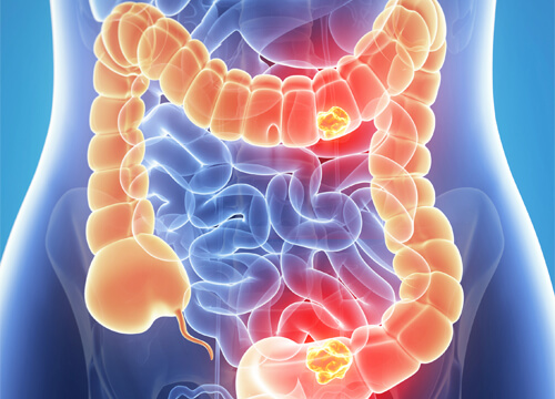 Habits that Damage Your Intestines - Step To Health