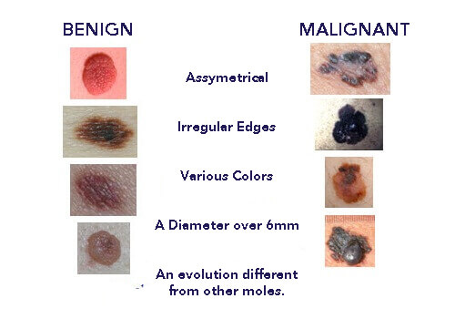 Abnormal and normal moles.