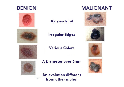 Normal Mole Variation Some Facts About Moles - Anatomy and physiology - Step To Health