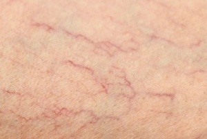 5 Natural Remedies for Spider Veins on Your Legs