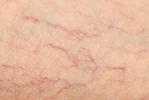 5 Natural Remedies for Spider Veins on Your Legs
