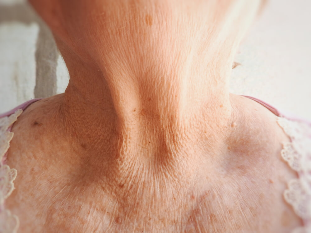 Remedies to Reduce Neck Wrinkles Step To Health
