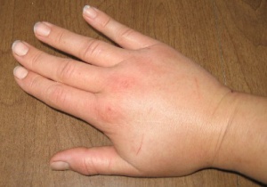 Natural Ways to Alleviate Fluid Retention