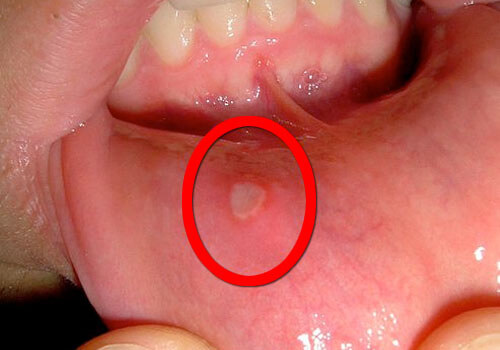 A mouth with a canker sore.