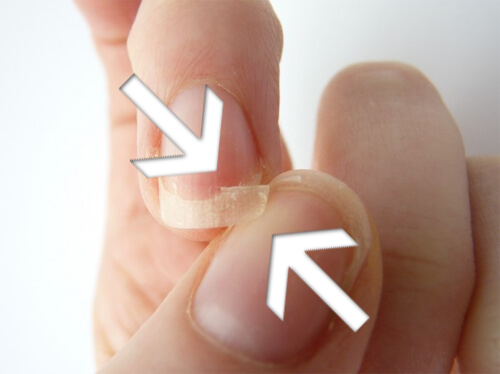 Person with brittle nails