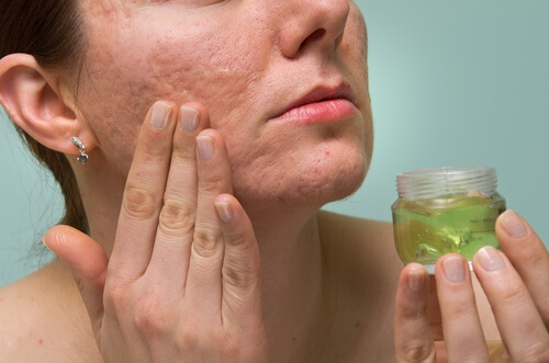 How to Get Rid of Acne Scars with 15 Natural Remedies