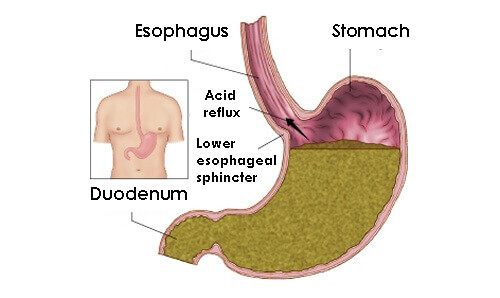 Gastric reflux
