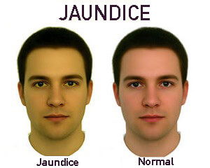 Comparing jaundiced skin with normal skin.