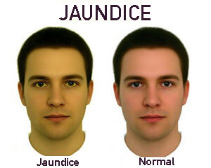 Jaundice