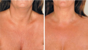 Remedies to Reduce Neck Wrinkles