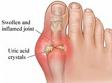 Dangers of Uric Acid and How to Avoid it