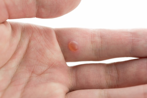 10 Natural Home Remedies for Warts