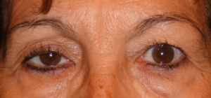 Natural Remedies for Sagging Eyelids