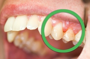 Natural Ways to Treat Gingivitis