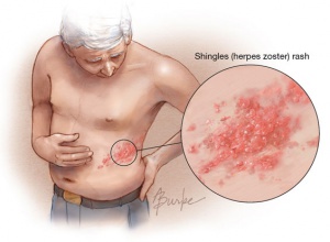 Natural Treatments for Shingles