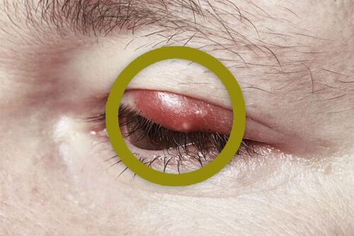 How to Treat Styes in the Eyes at Home