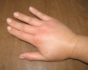 Natural Teas that Reduce Fluid Retention