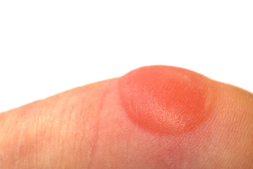 Natural treatments for shingles can help reduce your discomfort if you become affected