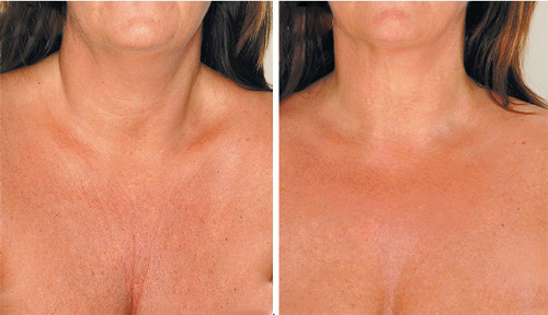 Food and Habits that Cause Premature Wrinkles