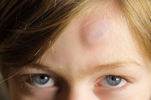 A head bump.