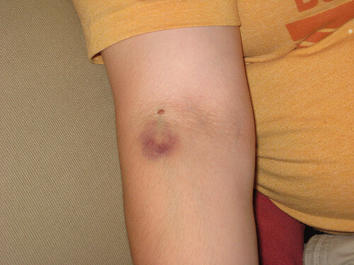 An arm bruise.