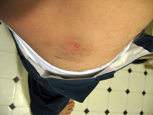 A nasty bruise.