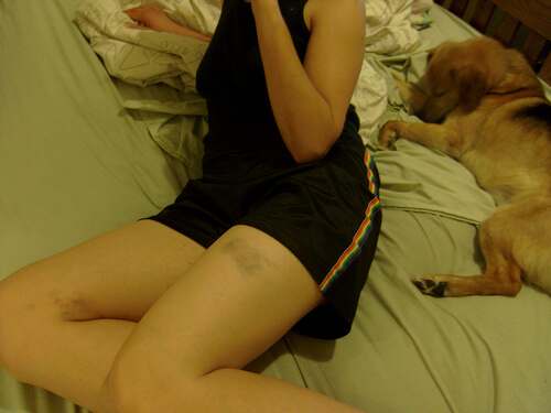 Woman with a bruise on her leg.