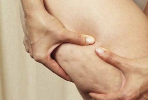 Foods that Cause Cellulite or Can Make It Worse