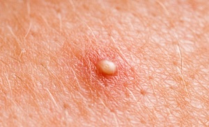 Homemade Remedies that may Help With Boils