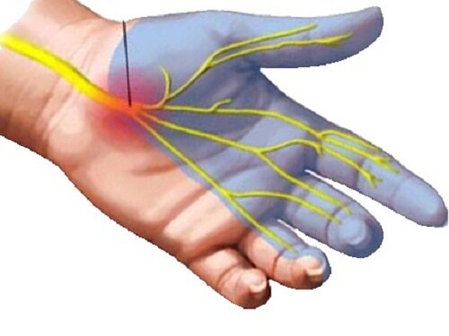 Carpal tunnel pain