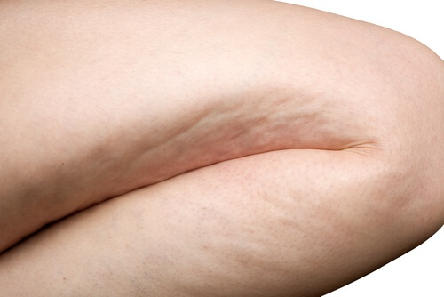 Natural Tips and Treatments for Cellulite