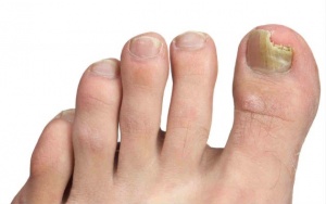 natural treatments for nail fungus